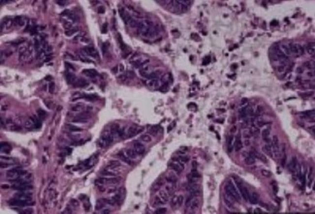 Препараты ткани легкого Novus Biologicals (аденокарцинома умеренно дифференцированная | Fisher Scientific